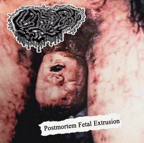 Fetal Deformity : Postmortem Fetal Extrusion